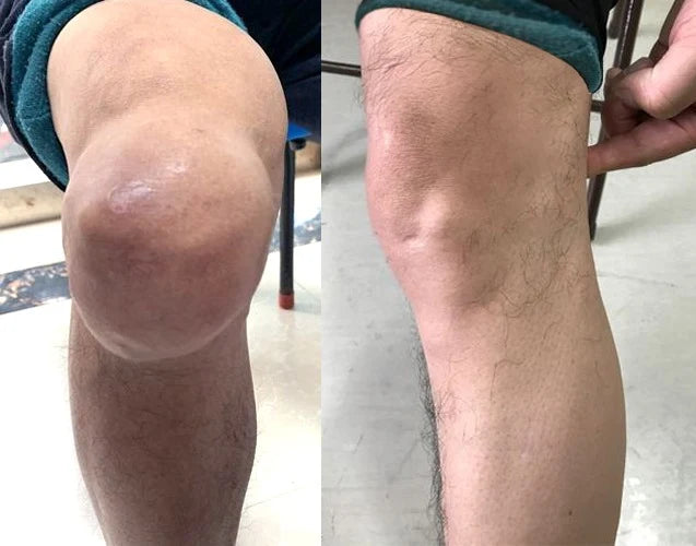 Noah Anderson knee pain relief result
