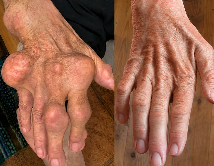 Mariah Jenkins gout relief result