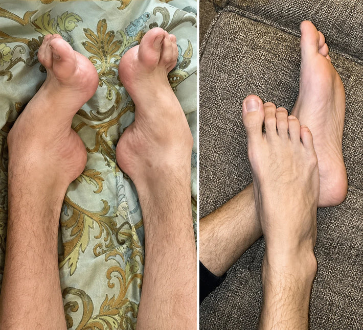 Benjamin gout feet relief result